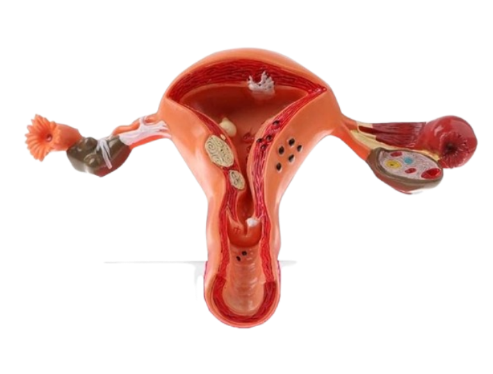 Model Human  Uterus Ovaries Pathology